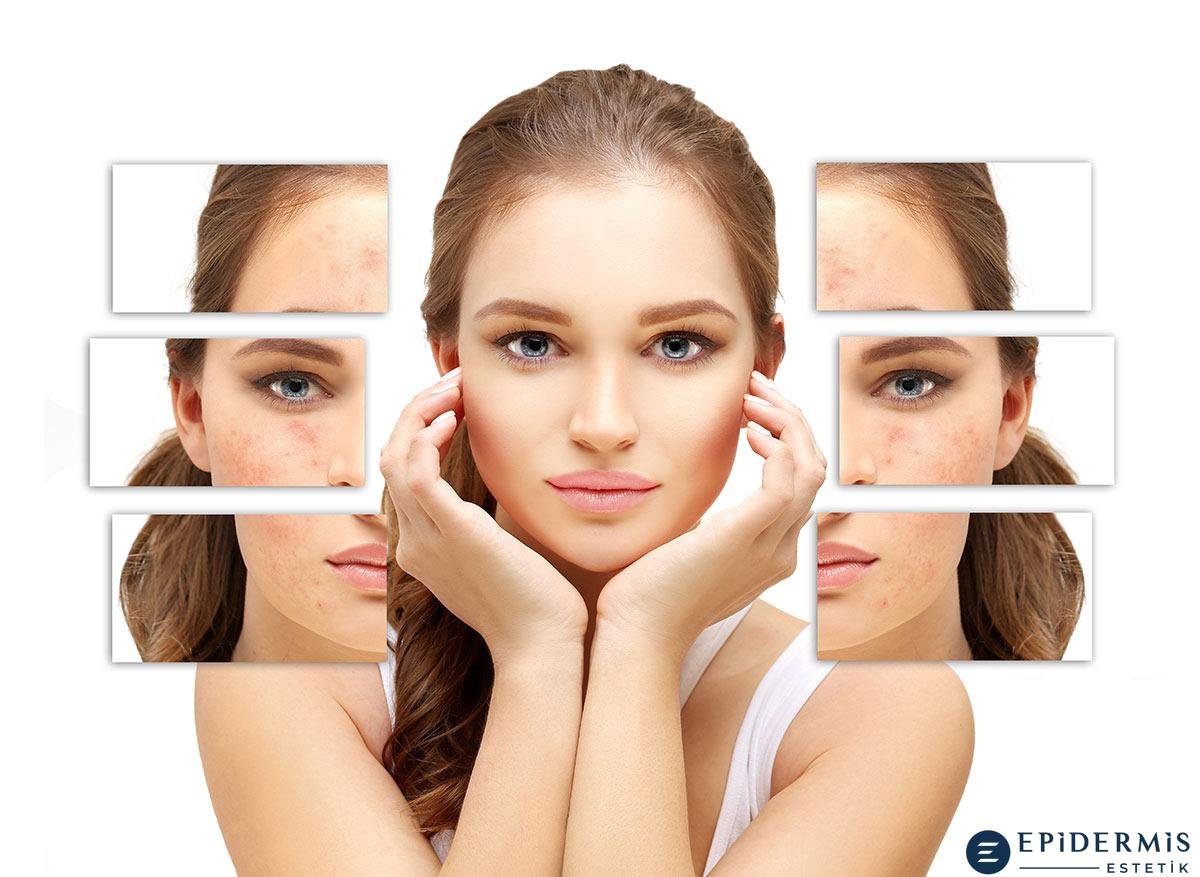 Sivilce ve Akne Tedavisi